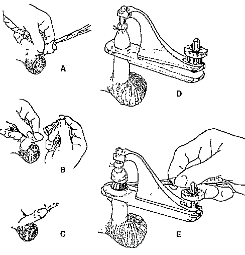 Circumcision with Gomco clamp