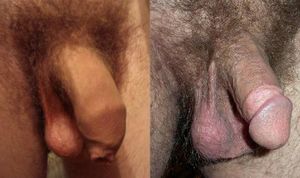 Intact vs circumcised.JPG