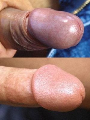 Keratinization intact vs circumcised.JPG